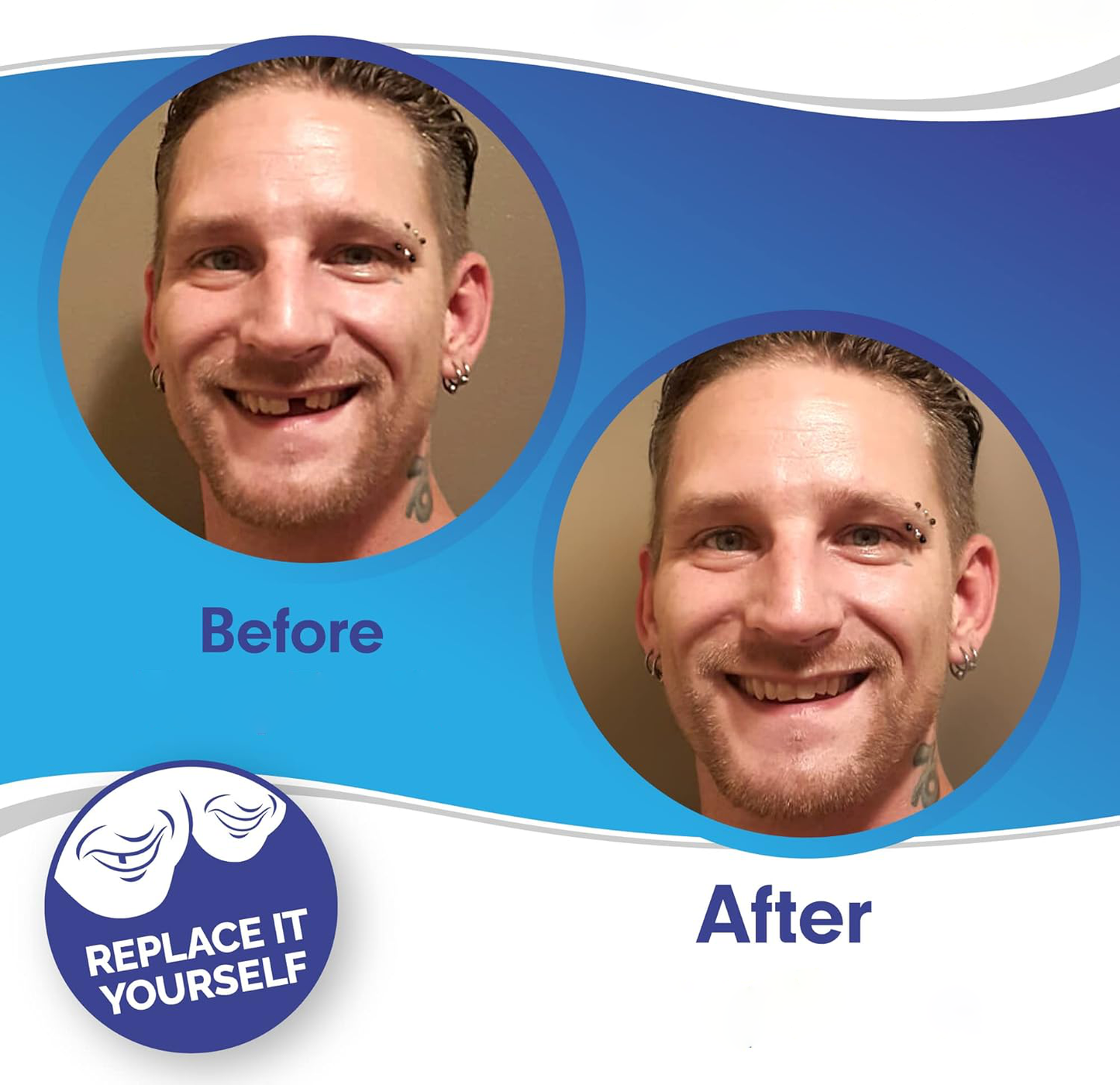 Clip-On Smile Veneers - Upper & Lower Set